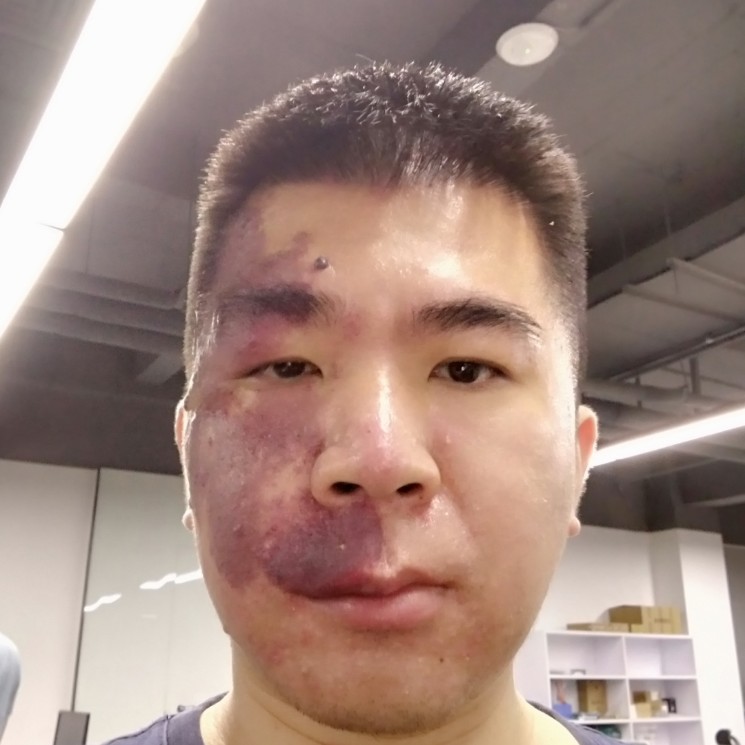 红胎记的照片